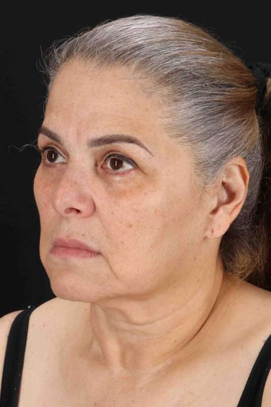 Face & Neck Lift Before & After Patient #3292