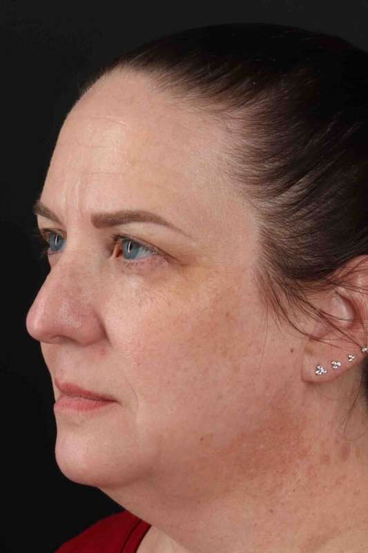Face & Neck Lift Before & After Patient #3303