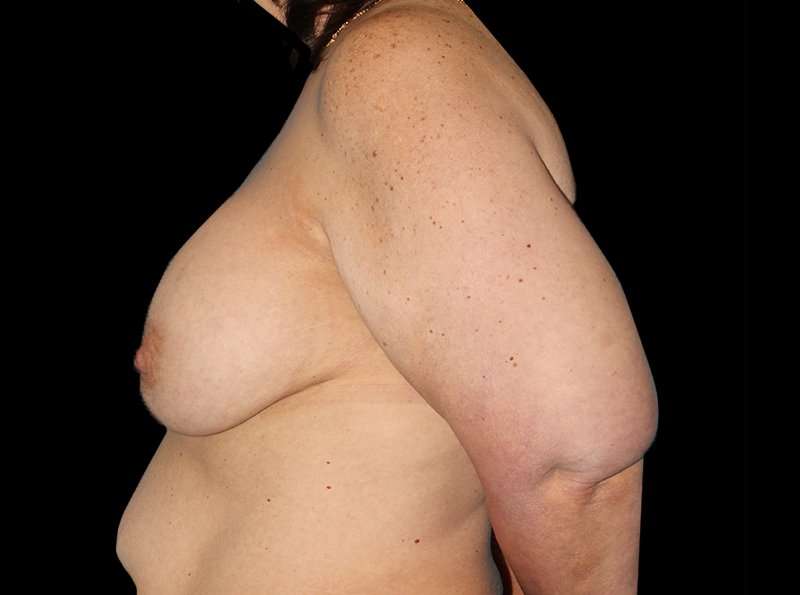 Revision Breast Surgery Before & After Patient #1195