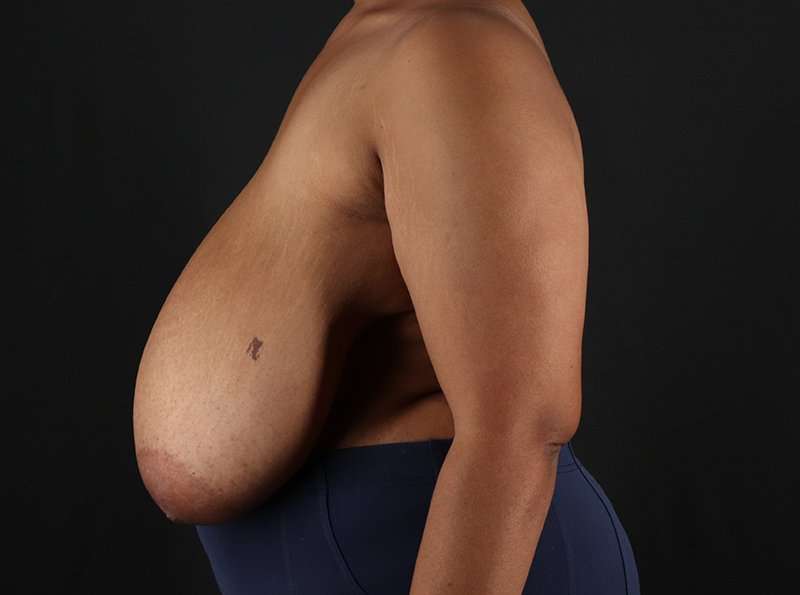 Breast Reduction Before & After Patient #1228