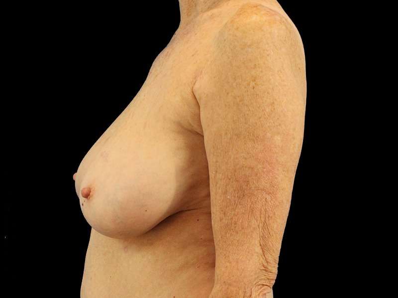 Breast Reduction Before & After Patient #1239