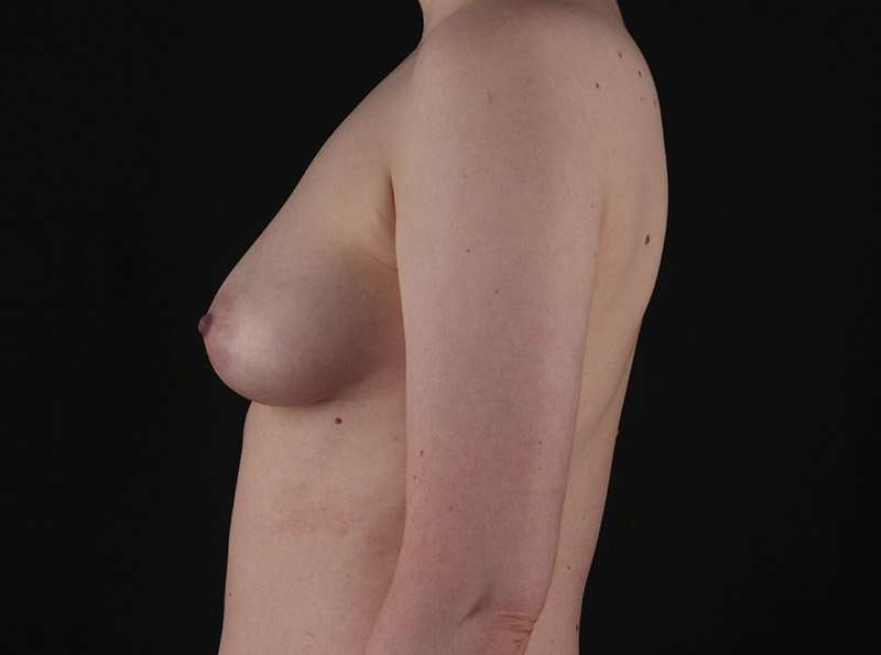 Breast Reduction Before & After Patient #1261