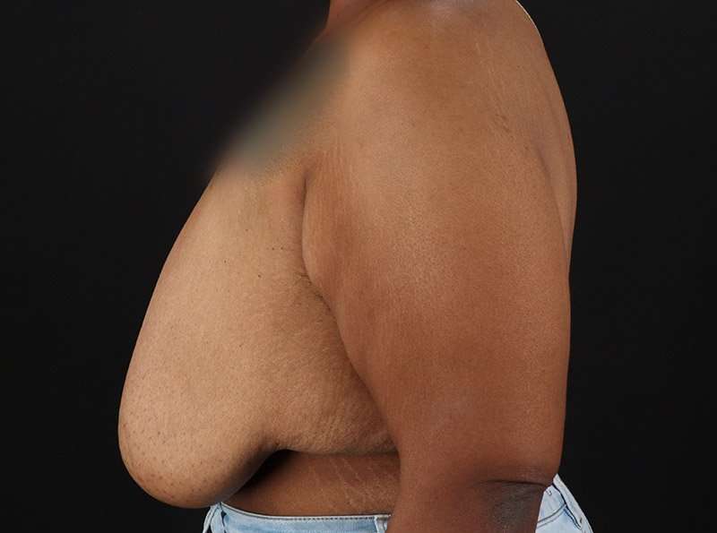Breast Reduction Before & After Patient #1272