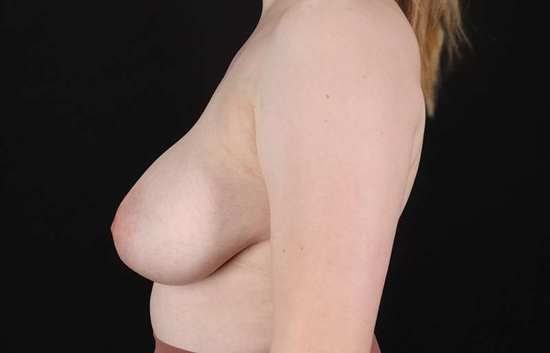 Breast Reduction Before & After Patient #1305