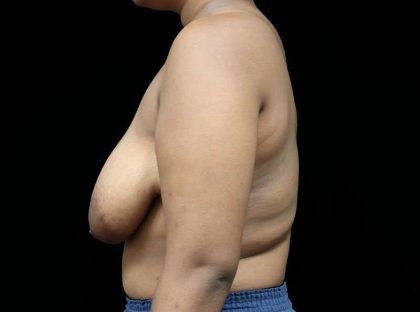 Breast Lift Before & After Patient #1343