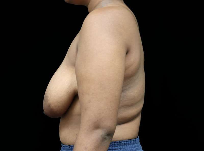 Breast Lift Before & After Patient #1343