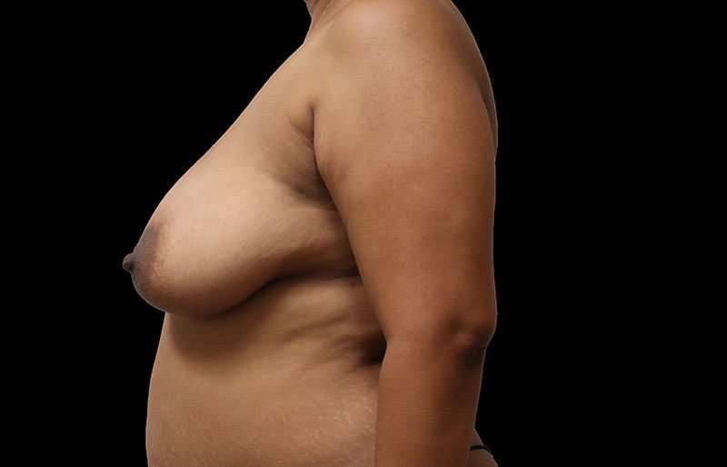 Breast Reduction Before & After Patient #1354