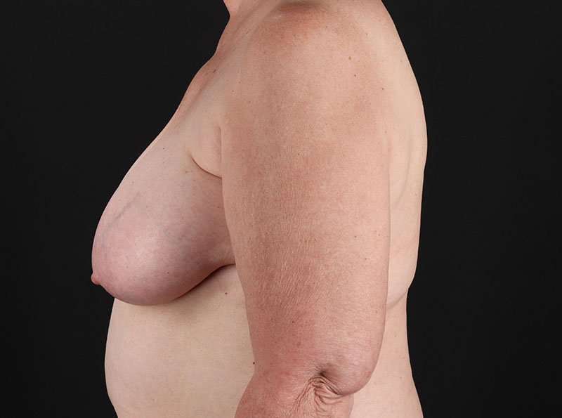 Breast Reduction Before & After Patient #1376