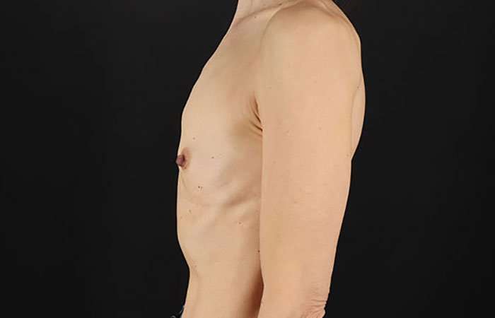 Breast Augmentation - Implant Before & After Patient #943