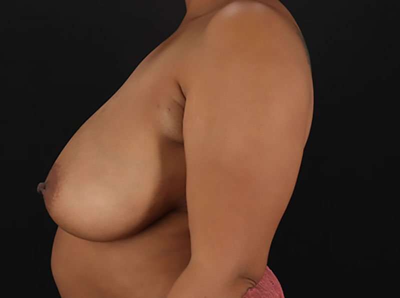 Breast Reduction Before & After Patient #1387