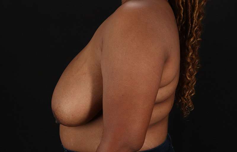 Breast Reduction Before & After Patient #1431