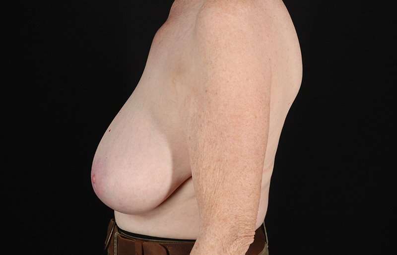 Breast Reduction Before & After Patient #1442