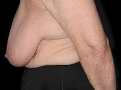 Breast Reduction Before & After Patient #1464