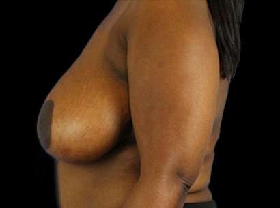 Breast Reduction Before & After Patient #1475