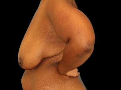 Breast Reduction Before & After Patient #1486