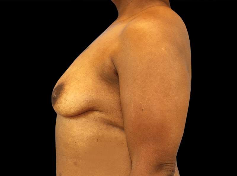 Breast Augmentation - Implant Before & After Patient #954