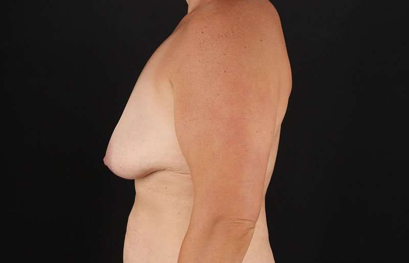 Augmentation/Lift Before & After Patient #1522