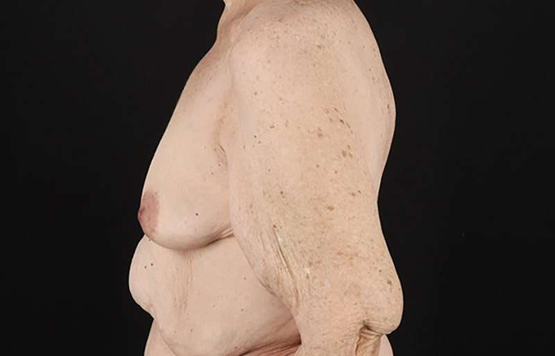 Augmentation/Lift Before & After Patient #1544