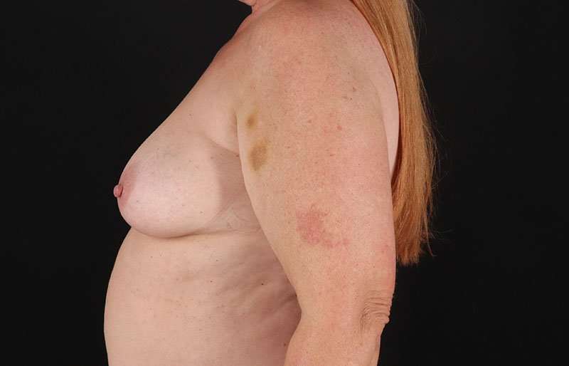 Breast Augmentation - Fat Transfer Before & After Patient #1557