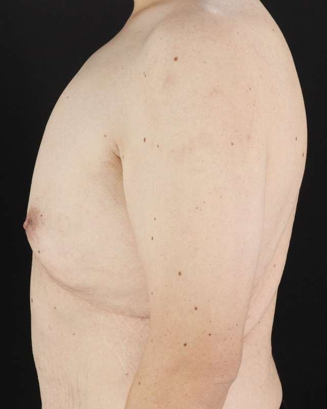 Gynecomastia Before & After Patient #1603