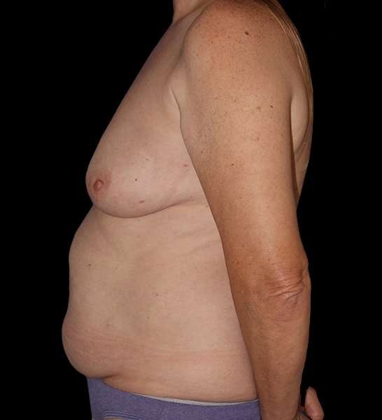 DIEP Flap Reconstruction Before & After Patient #1634