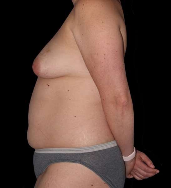 DIEP Flap Reconstruction Before & After Patient #1645