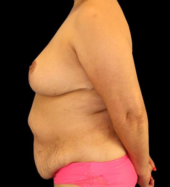 DIEP Flap Reconstruction Before & After Patient #1663