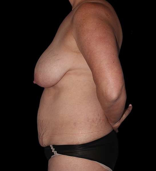 DIEP Flap Reconstruction Before & After Patient #1674