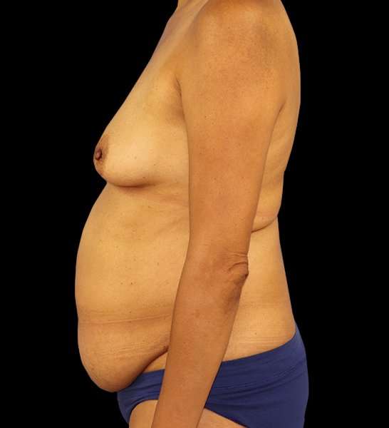 DIEP Flap Reconstruction Before & After Patient #1696