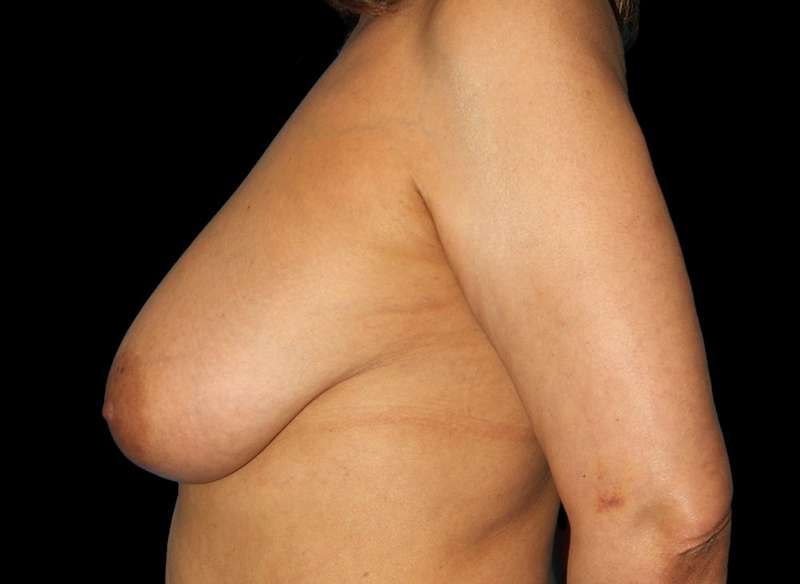 DIEP Flap Reconstruction Before & After Patient #1707