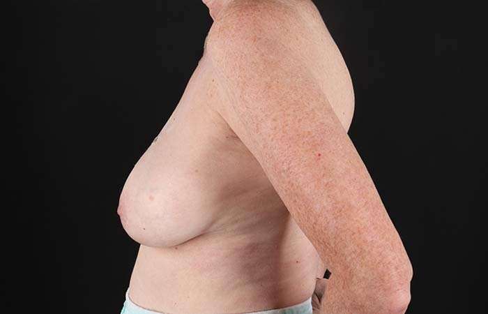 Implant Based Breast Reconstruction Before & After Patient #1718