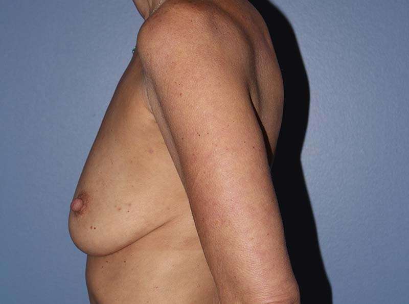 Implant Based Breast Reconstruction Before & After Patient #1729