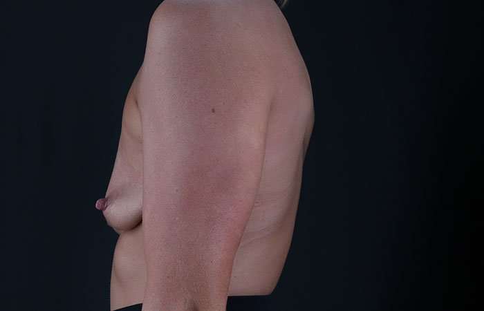 Breast Augmentation - Implant Before & After Patient #990
