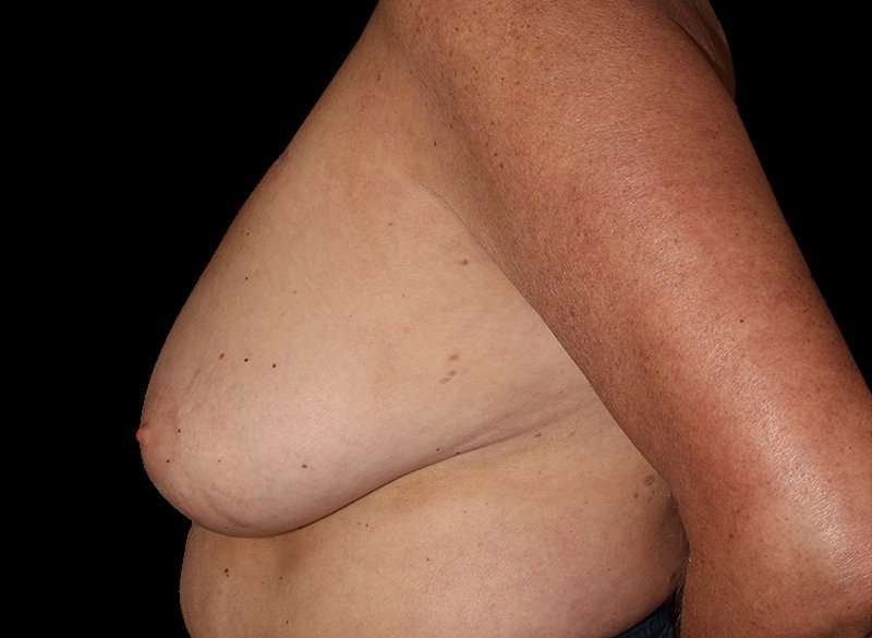 Oncoplastic Reconstruction Before & After Patient #1762