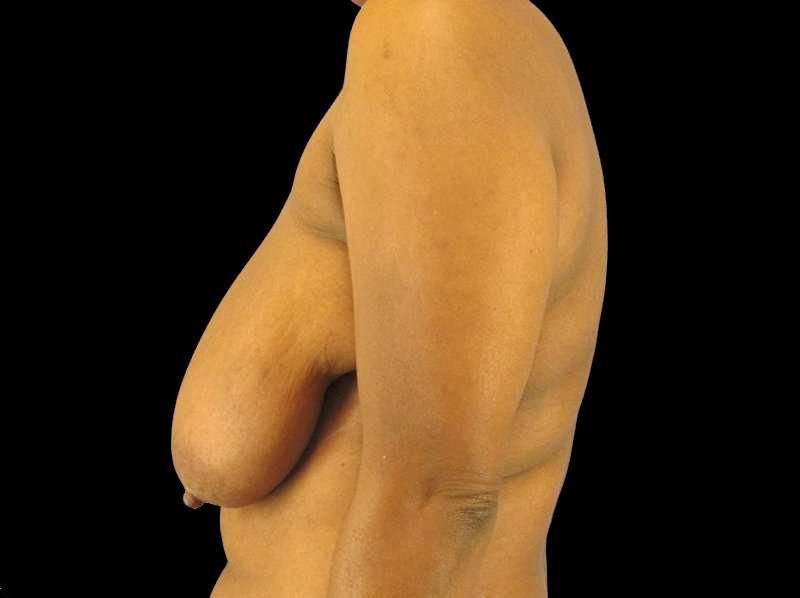 Oncoplastic Reconstruction Before & After Patient #1784
