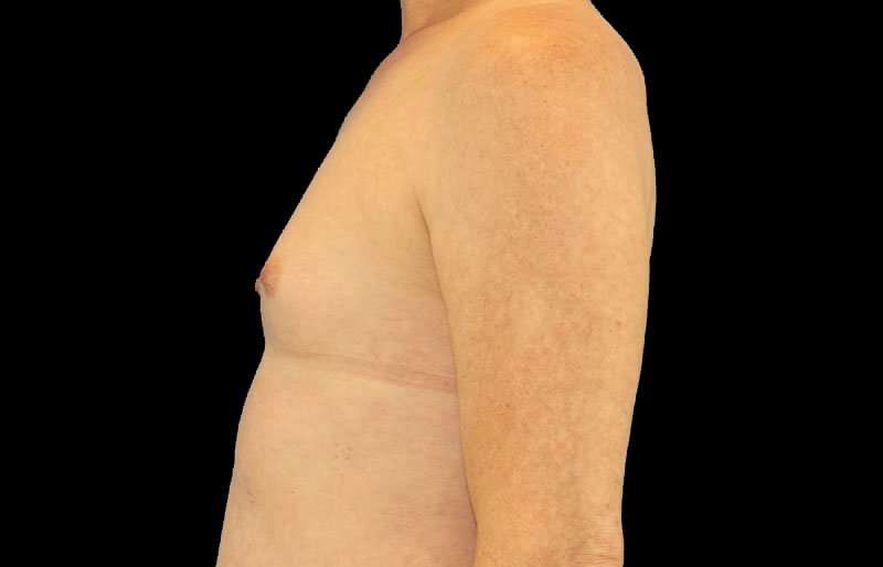 MTF Breast Augmentation Before & After Patient #1820