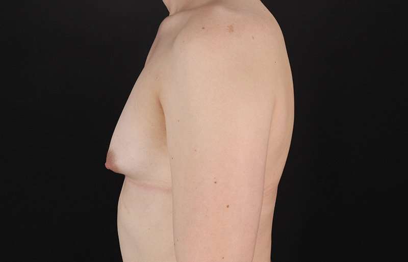 MTF Breast Augmentation Before & After Patient #1842
