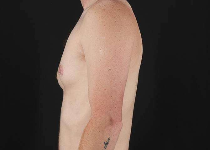 FTM Chest Contouring Before & After Patient #1864