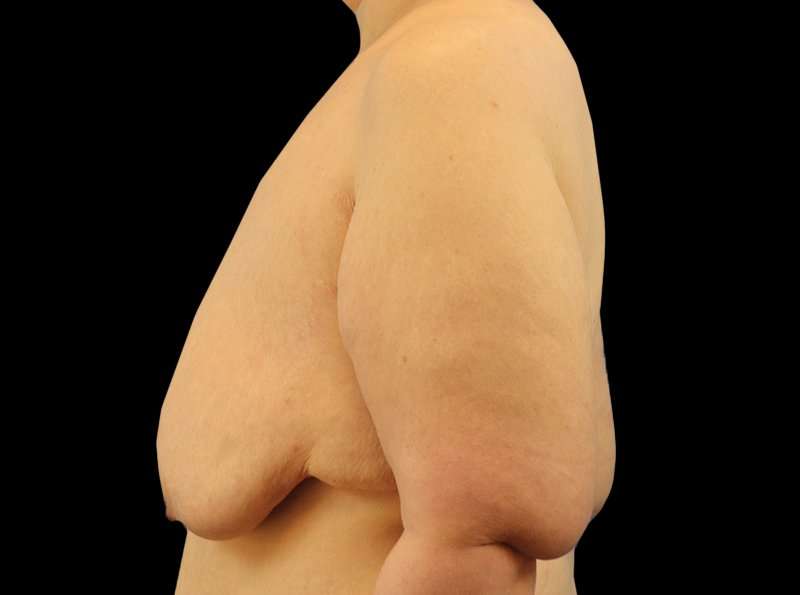 FTM Chest Contouring Before & After Patient #1875