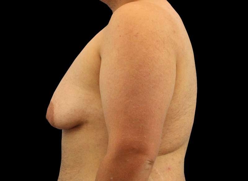 FTM Chest Contouring Before & After Patient #1886