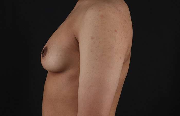 FTM Chest Contouring Before & After Patient #1929