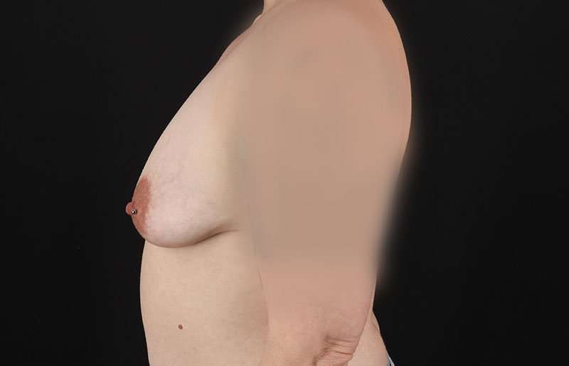 FTM Chest Contouring Before & After Patient #1973