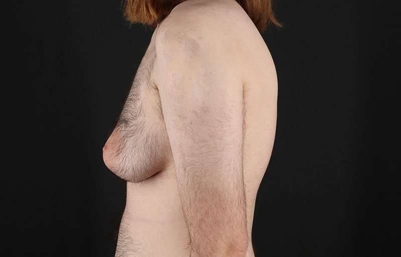 FTM Chest Contouring Before & After Patient #1984