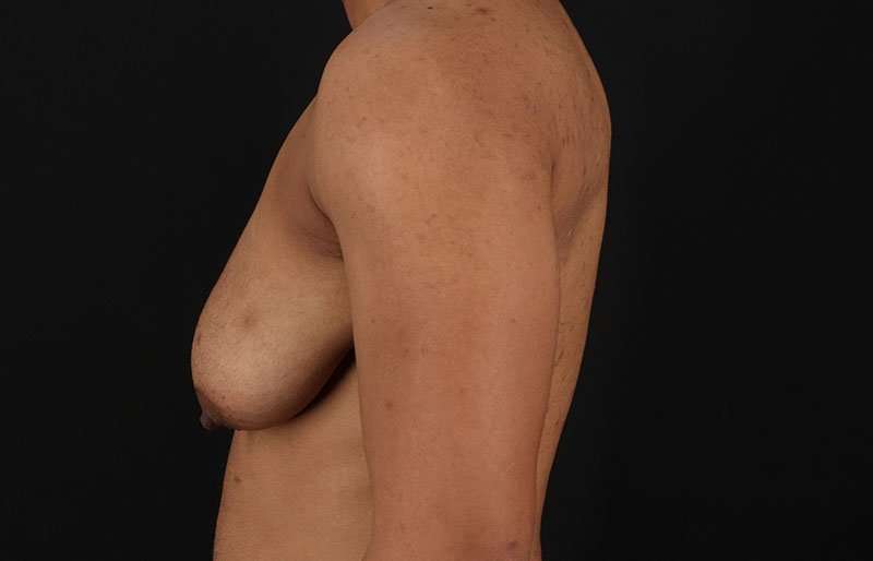 FTM Chest Contouring Before & After Patient #1995