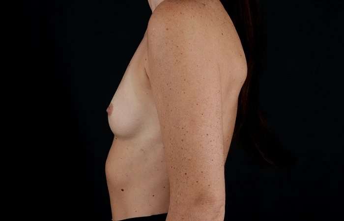 Breast Augmentation - Implant Before & After Patient #1012