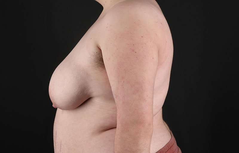 FTM Chest Contouring Before & After Patient #2006