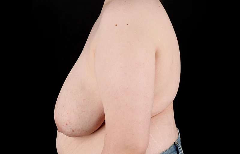 FTM Chest Contouring Before & After Patient #2039