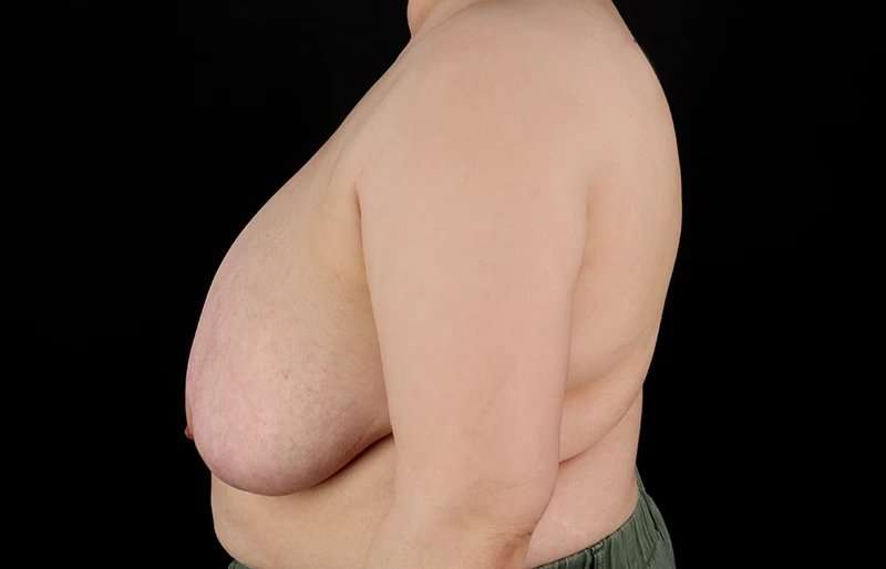 FTM Chest Contouring Before & After Patient #2050