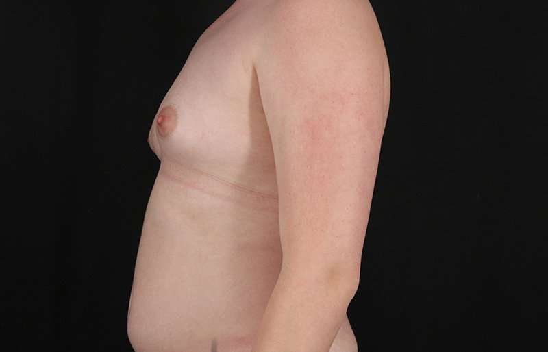 FTM Chest Contouring Before & After Patient #2072