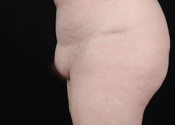 Monsplasty Before & After Patient #2106